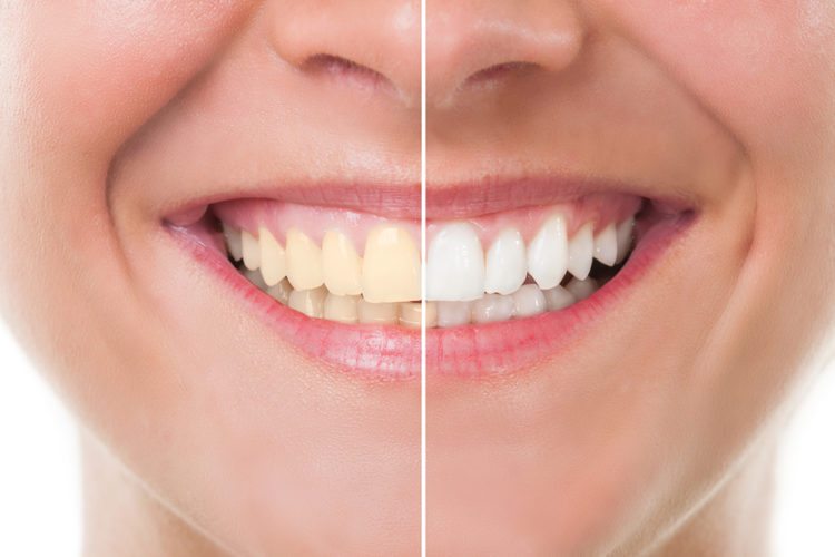 teeth whitening services with C & C Dentistry