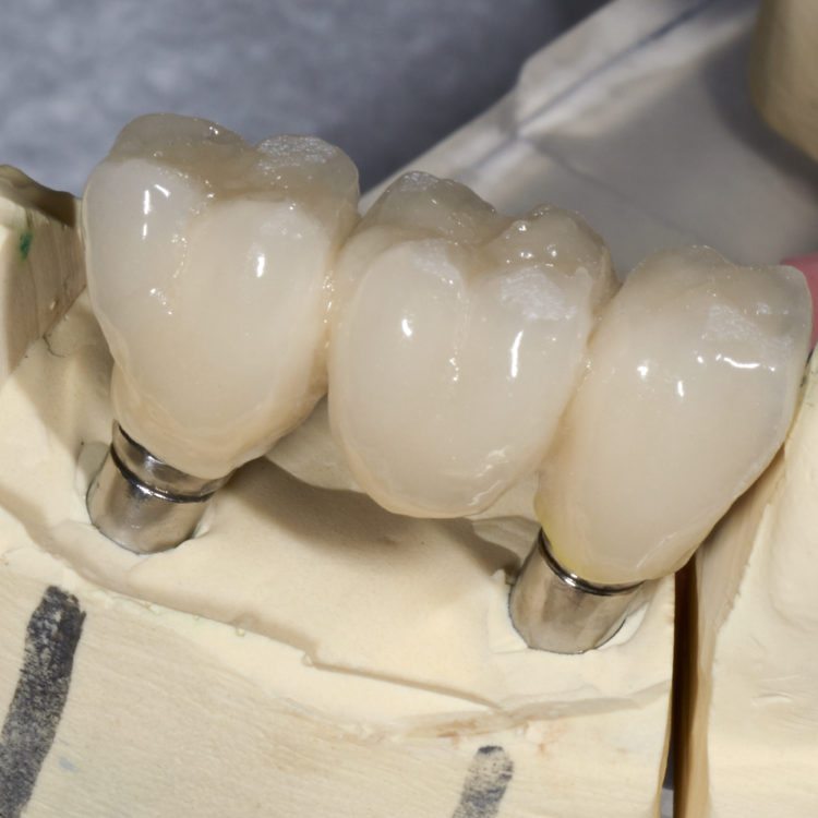 closeup for a dental ceramic bridge on a cast model