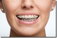 adult woman with braces